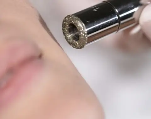 Microdermabrasion