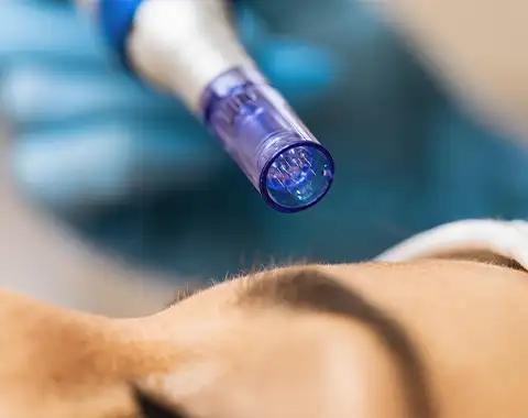 Microneedling